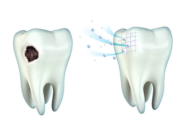 歯の再石灰化について