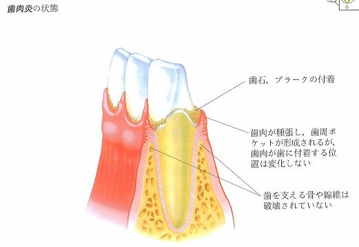 歯周病のチェック２