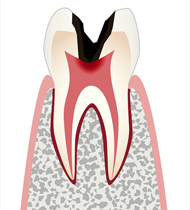 神経の虫歯