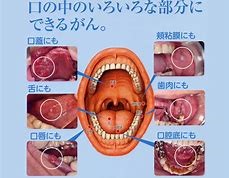 口腔がん検診