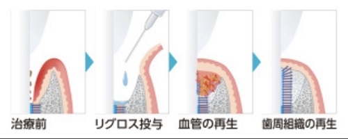 歯周病臨床研修会【リグロス】