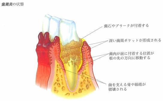 歯周病のチェック２