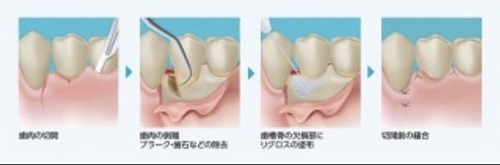 歯周病臨床研修会【リグロス】