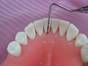 歯周病のチェック