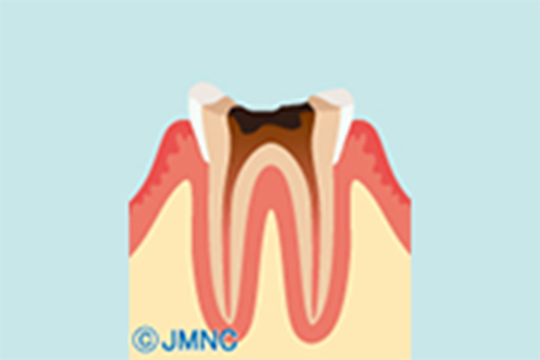 虫歯の部分を丁寧に削り、歯根もきれいにします。