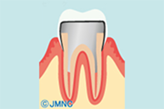 セラミックのクラウンを土台に装着して仕上げます。