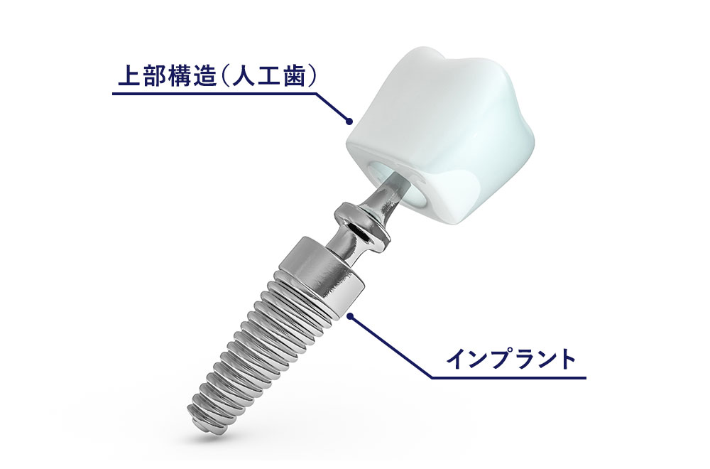 インプラント治療設置に関して（概算金額）