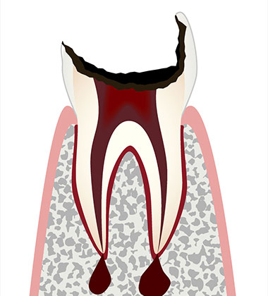 神経が死んだ虫歯