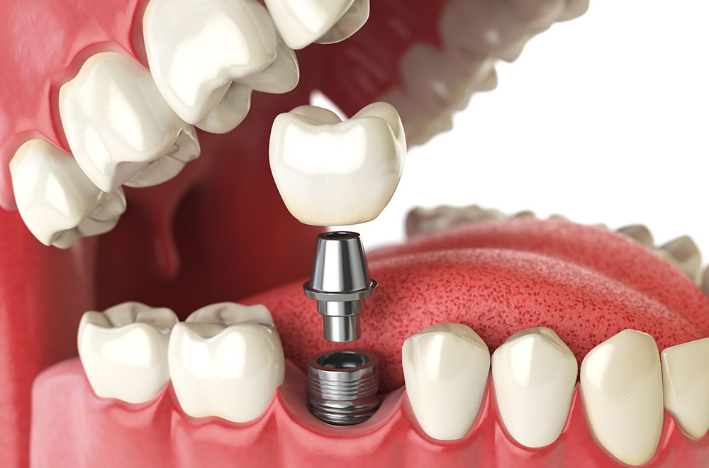 インプラント治療とは
