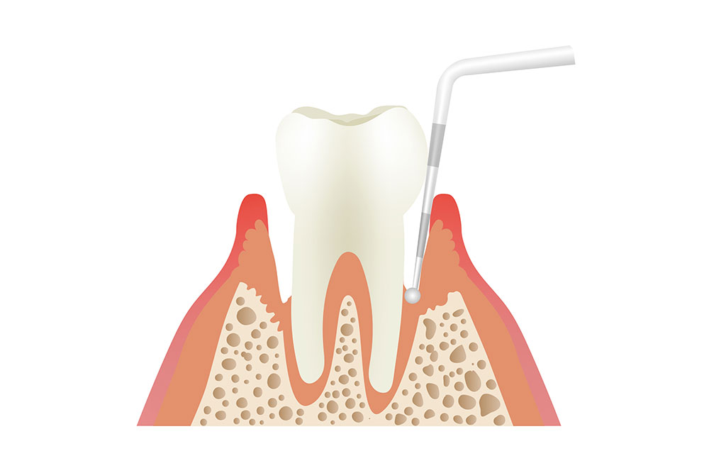 歯周病のチェック
